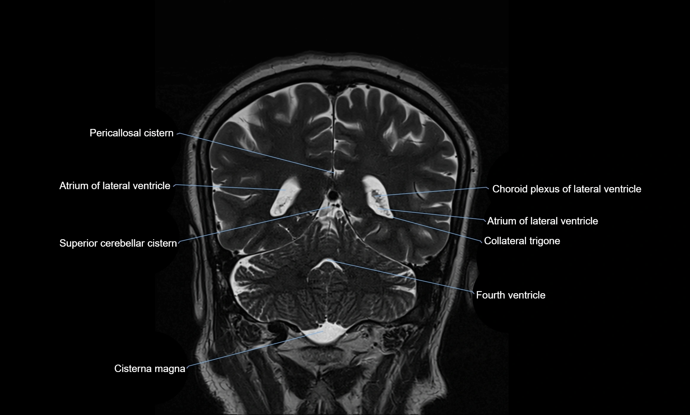Brain cisterns  and ventricles coronal anatomy 3T MRI image-img-00001-00043.webp